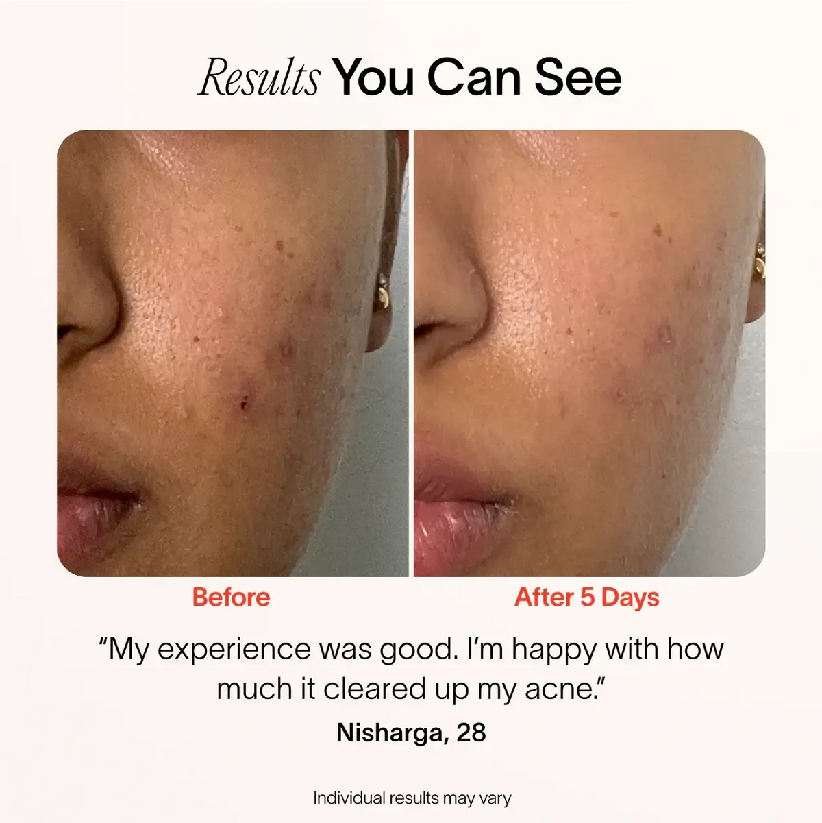 Solawave Bye Acne: 3-Minute Pimple Spot Treatment