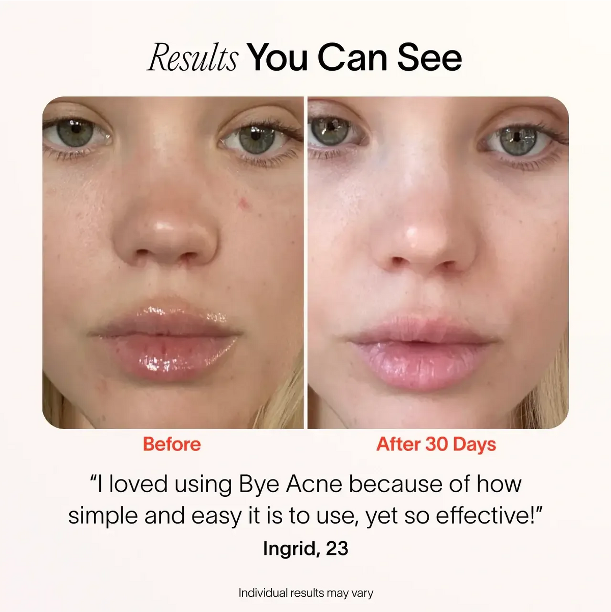 Solawave Bye Acne: 3-Minute Pimple Spot Treatment